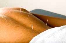 Man laying on stomach with acupuncture needles in his back.