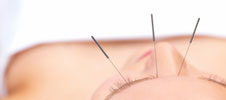 Facial rejuvination acupuncture on a woman.